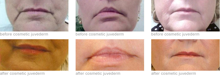 juvederm